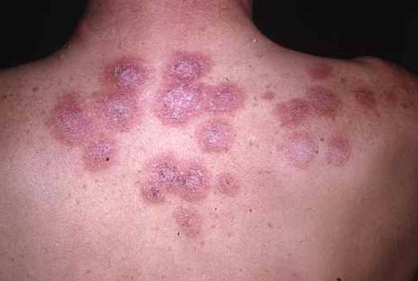 quelle pillule pour acné