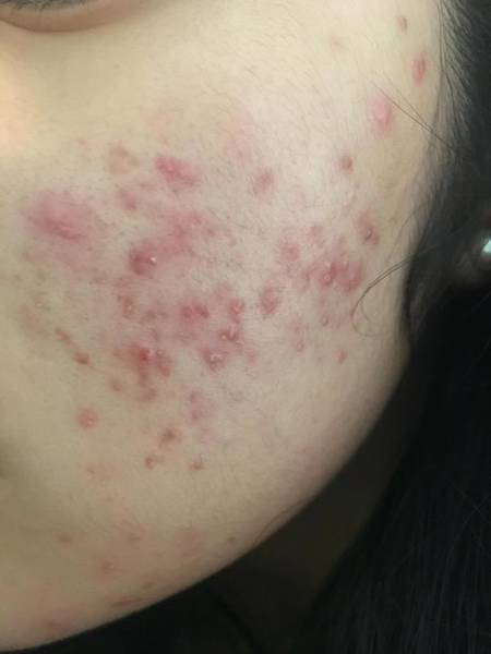 avene ou la roche posay acne