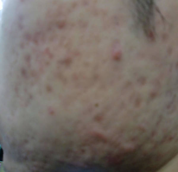 comment enlever cicatrice acne