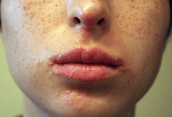 comment enlever l acné naturellement