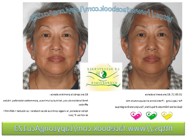 acupuncture le vesinet