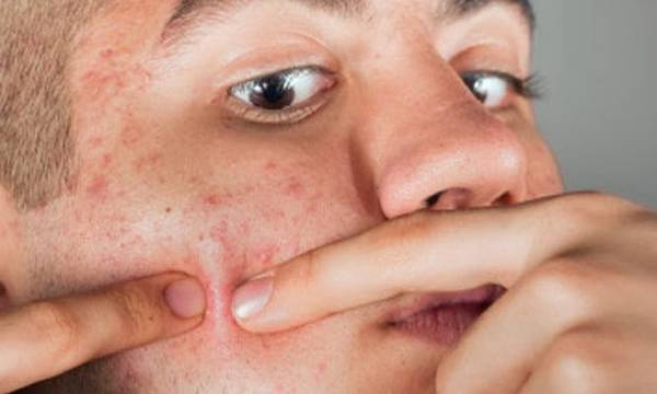 acné qui persiste