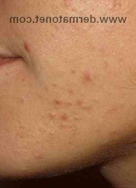 bouton levre acné ou herpes