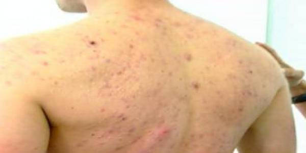 pilule qui donne acne
