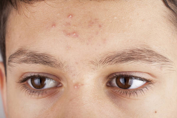 comment enlever acné du nourrisson