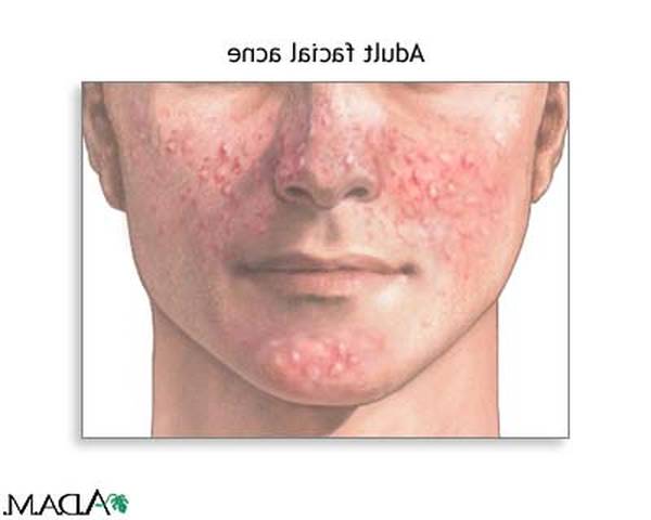 comment ne plus avoir de boutons d acné naturellement