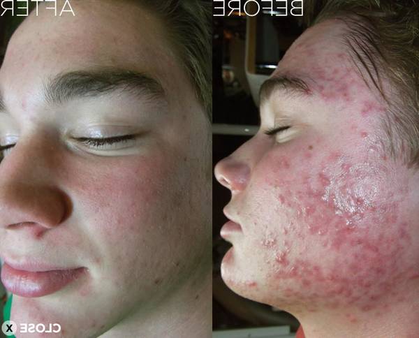 produit acné qui marche