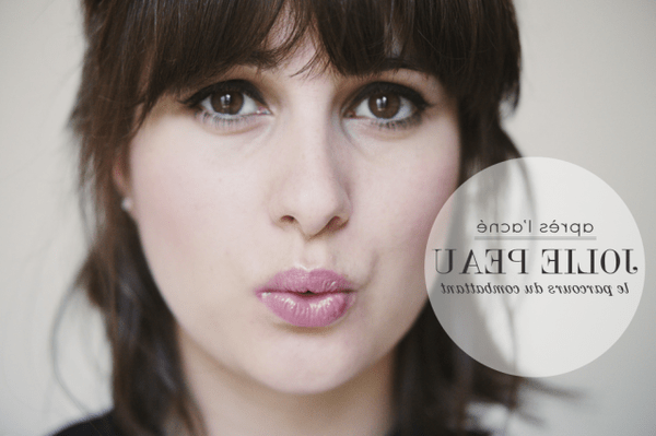 quelle pilule pour acne hormonale