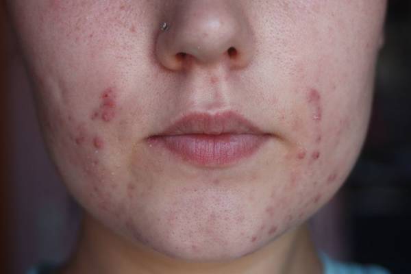 quelle est la meilleur creme anti acné quelle est la meilleur creme anti acné