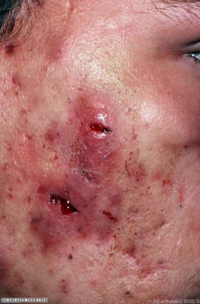 boutons acné qui grattent