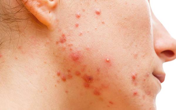 acne qui ne sort pas
