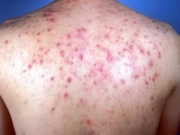 au bout de combien de temps partent les taches d acné