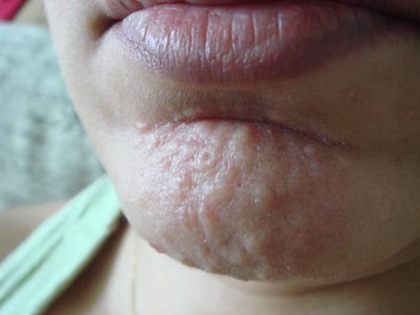 comment stopper l acné