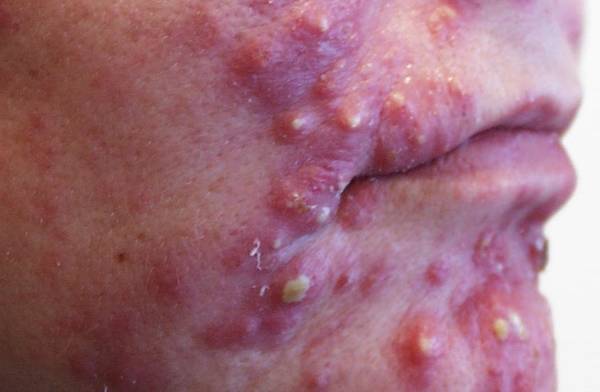 pourquoi acné visage