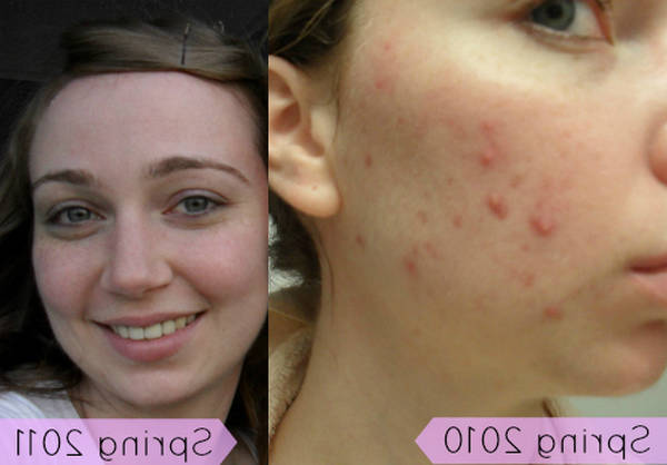 acné comment se laver le visage