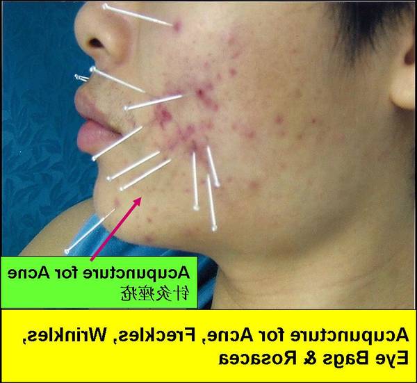 combien de temps dure l acne du nourrisson