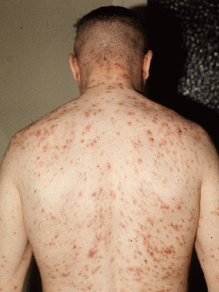 dermite séborrhéique ou acné