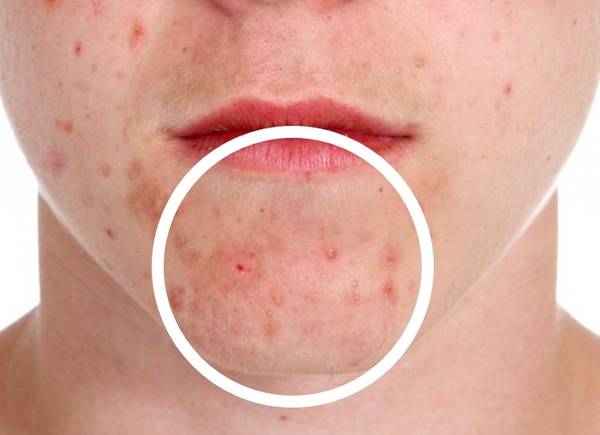 bouton acné qui ne sort pas