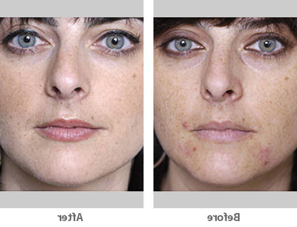 comment faire disparaitre son acné naturellement