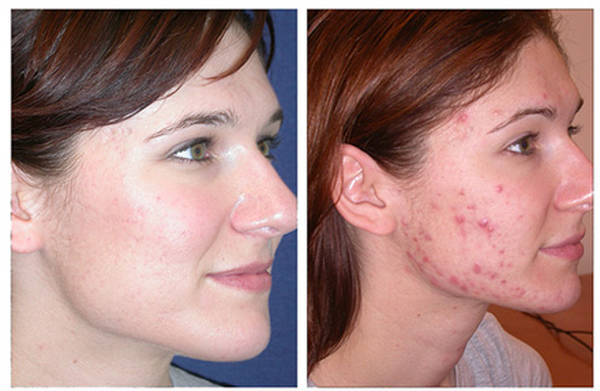 comment soigner acne bebe