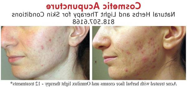 acupuncteur cannes avis