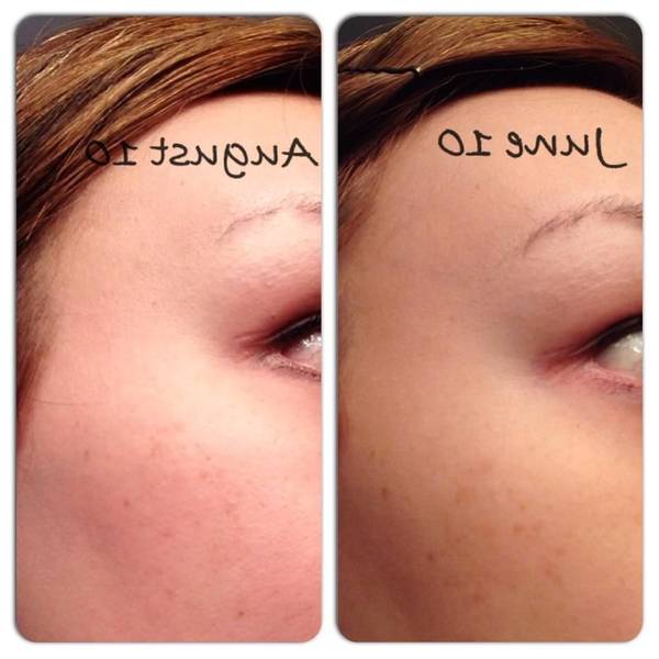 tetralysal acné combien de temps