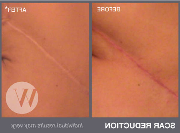 comment traiter l acne