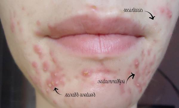 acné comment s'en débarrasser rapidement