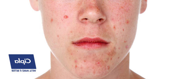 quelle pilule prendre contre l acné