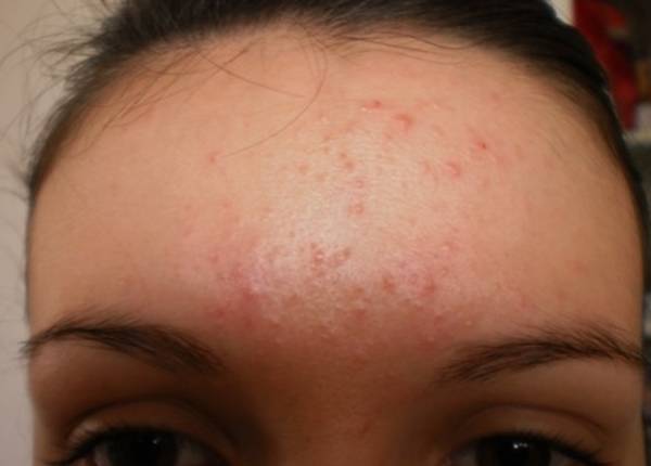 comment réduire les cicatrices d acné