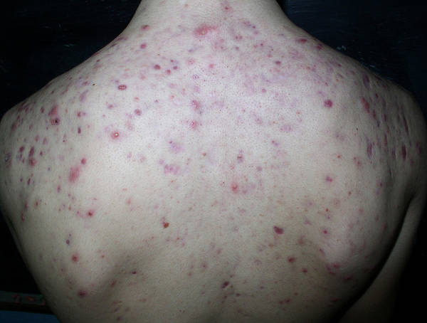 acne peau seche ou grasse