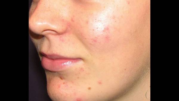 acné ou herpes acné ou herpes