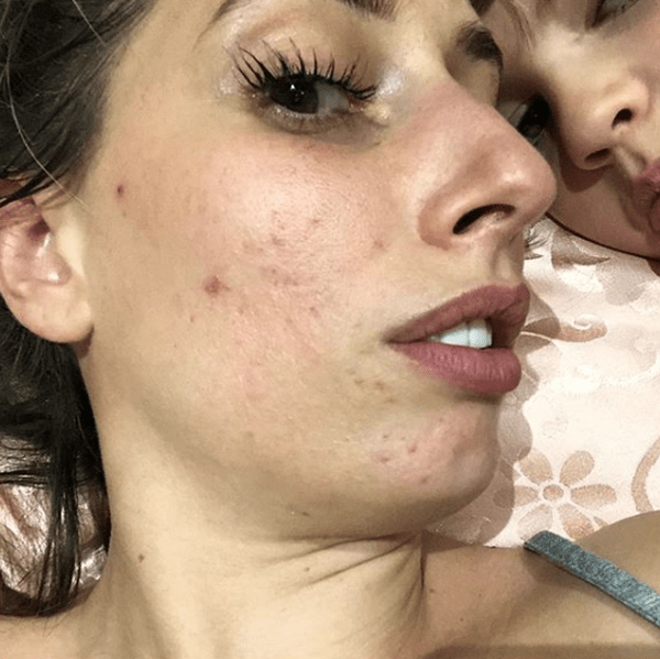 bouton acné qui font mal