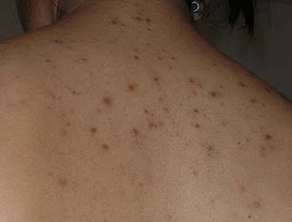 comment enlever les boutons d acné sur le nez