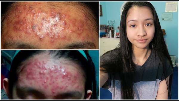 comment avoir une peau sans acné