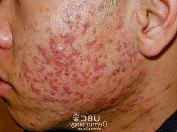 diane 35 ou yasmin para acne