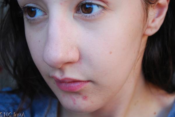 acne visage grossesse fille ou garcon