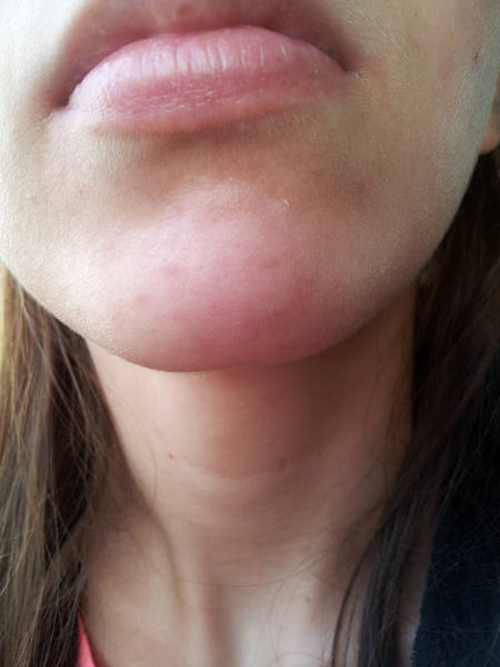 comment avoir une belle peau apres l acné