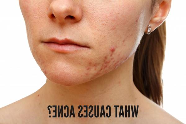 comment enlever les boutons d acné