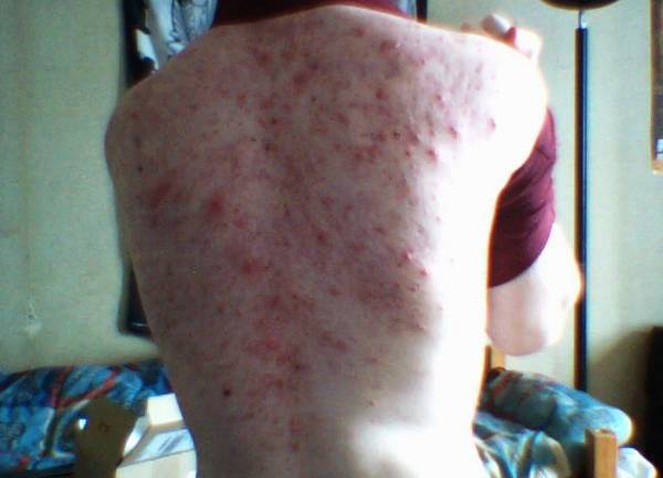 pilule qui donne acne