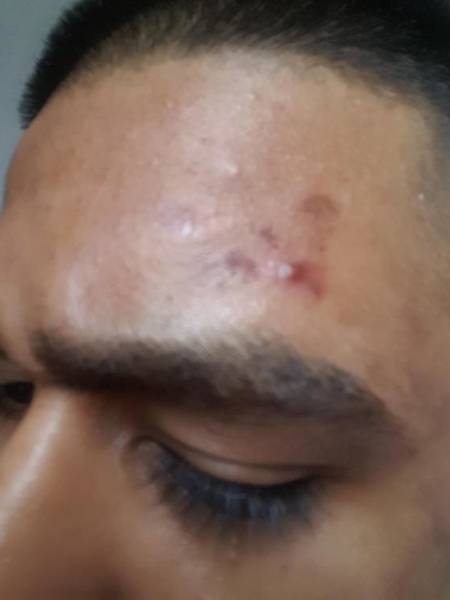 acne qui veut pas sortir