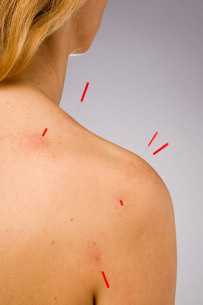 acupuncture yvelines