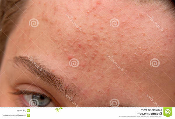 levure de biere acné combien de temps