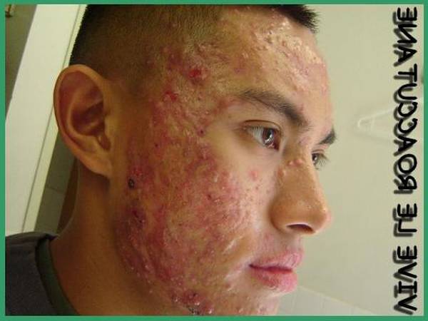 diane 35 acné effet au bout de combien de temps