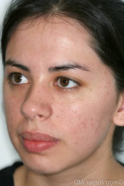 produit acné qui marche