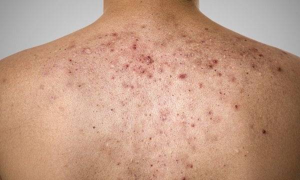 comment se débarrasser des taches d acné