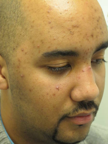 comment enlever les boutons d acné sur le visage ?