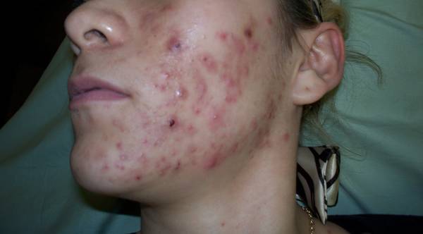 acné combien de temps ca dure