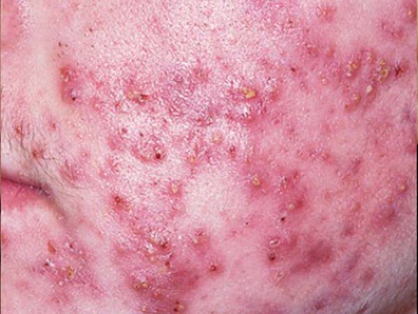 quelle huile essentielle pour acné quelle huile essentielle pour acné