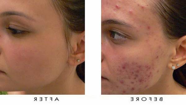 comment enlever les boutons d acné